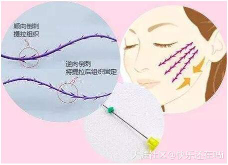 被骗了？线雕对怀孕有影响吗？pst面部提升和线雕的区别安排上了(转载)